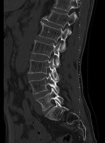 File:Baastrup syndrome (Radiopaedia 64891-73838 Sagittal bone window 16).jpg