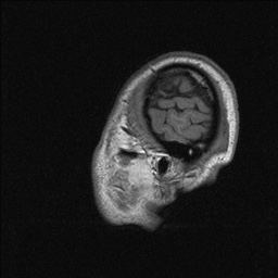 Balo concentric sclerosis (Radiopaedia 50458-55940 Sagittal T1 142).jpg