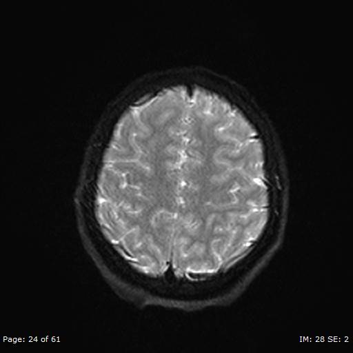 Balo concentric sclerosis (Radiopaedia 61637-69636 Axial DWI 24).jpg