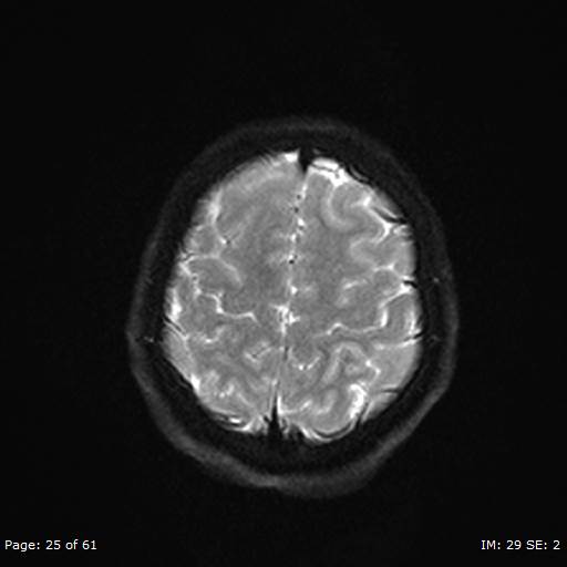 Balo concentric sclerosis (Radiopaedia 61637-69636 Axial DWI 25).jpg