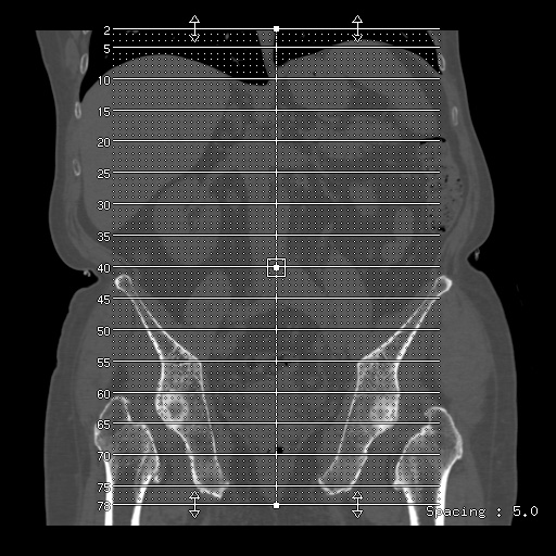 File:Bamboo spine (Radiopaedia 61848-69879 Axial bone window 1).jpg