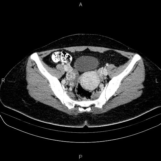 File:Bartholin gland cyst (Radiopaedia 62635-70930 Axial Post contrast 36).jpg