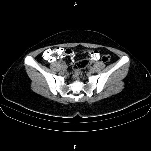 Bartholin gland cyst (Radiopaedia 62635-70930 Axial non-contrast 28).jpg