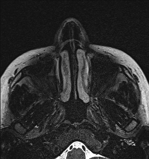 File:Basal cell carcinoma - nasal region (Radiopaedia 70292-80365 Axial Gradient Echo 1).jpg