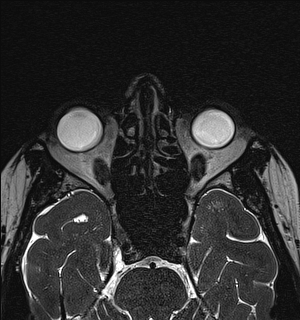 Basal cell carcinoma - nasal region (Radiopaedia 70292-80365 Axial Gradient Echo 66).jpg
