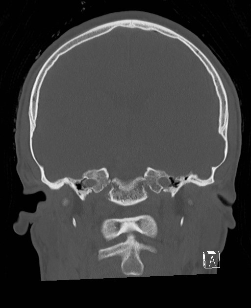 Base of skull fracture with bilateral Le Fort fractures (Radiopaedia 47094-51638 Coronal bone window 47).jpg