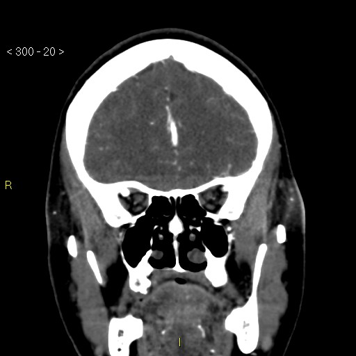 Basilar artery thrombosis (Radiopaedia 16260-15944 B 11).jpg
