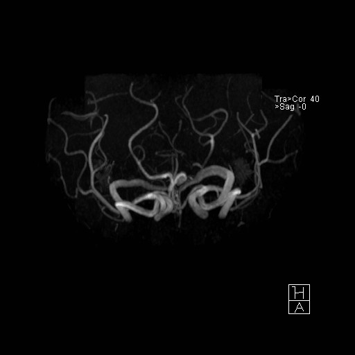 Basilar tip aneurysm (Radiopaedia 26504-26632 D 23).jpg