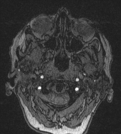 Basilar tip aneurysm (Radiopaedia 26504-26632 MRA 3).jpg