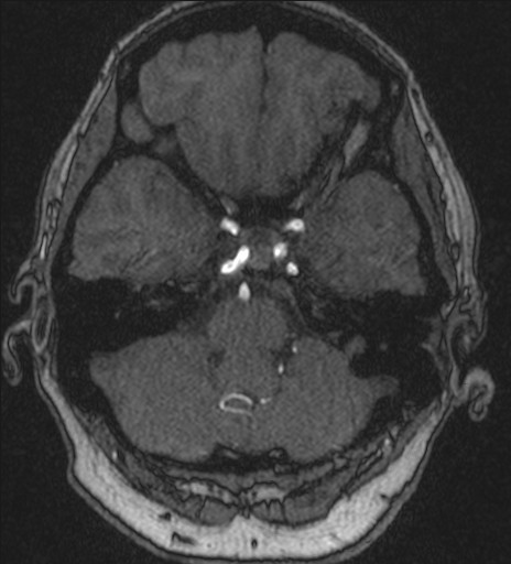 File:Basilar tip aneurysm (Radiopaedia 26504-26632 MRA 50).jpg