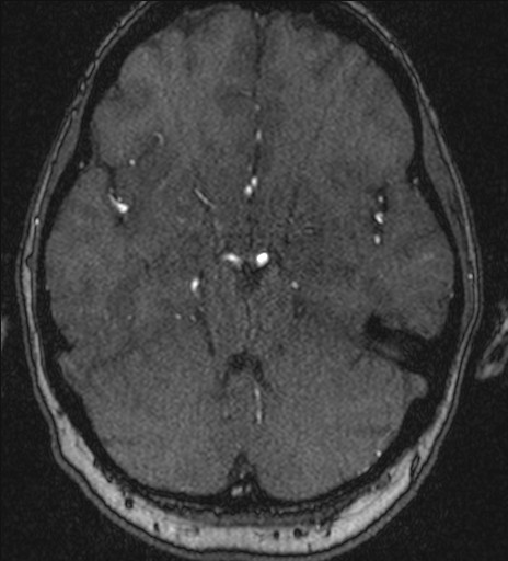 Basilar tip aneurysm (Radiopaedia 26504-26632 MRA 82).jpg