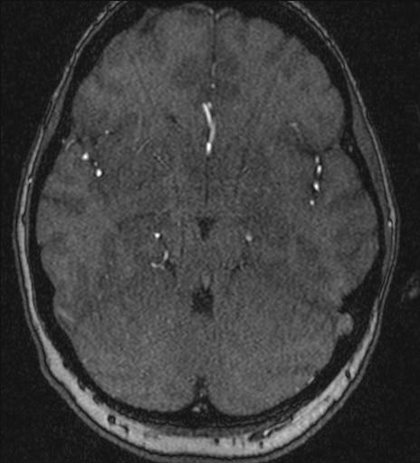 File:Basilar tip aneurysm (Radiopaedia 26504-26632 MRA 88).jpg