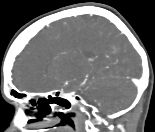 Basilar tip aneurysm with coiling (Radiopaedia 53912-60086 C 50).jpg