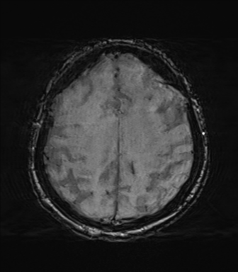 File:Behavioral variant frontotemporal dementia and late onset schizophrenia (Radiopaedia 52197-58083 Axial SWI 56).png