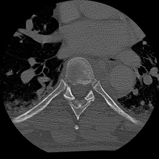 Benign post-traumatic pseudopneumoperitoneum (Radiopaedia 71199-81495 Axial bone window 101).jpg