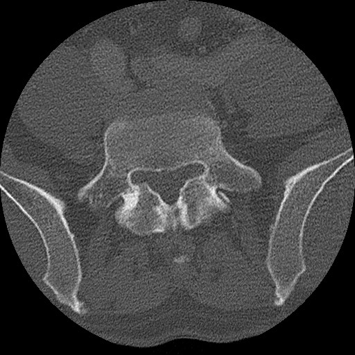 Benign post-traumatic pseudopneumoperitoneum (Radiopaedia 71199-81495 Axial bone window 273).jpg