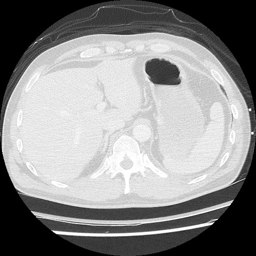 File:Benign post-traumatic pseudopneumoperitoneum (Radiopaedia 71199-81495 Axial lung window 66).jpg