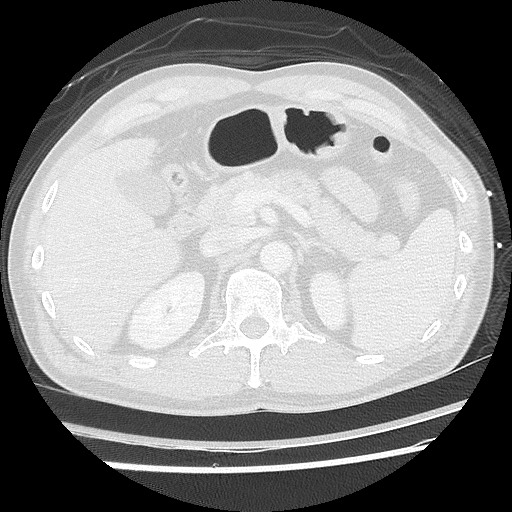 Benign post-traumatic pseudopneumoperitoneum (Radiopaedia 71199-81495 Axial lung window 73).jpg