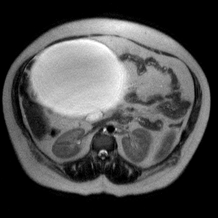 File:Benign seromucinous cystadenoma of the ovary (Radiopaedia 71065-81300 Axial T2 9).jpg