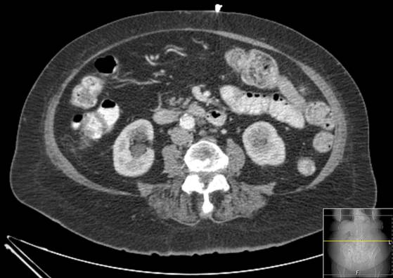 Bicameral celiacomesenteric aneurysm (Radiopaedia 55766-62327 A 33).jpg
