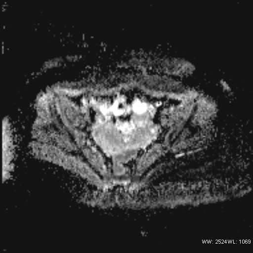 File:Bicornuate uterus- on MRI (Radiopaedia 49206-54297 Axial ADC 12).jpg
