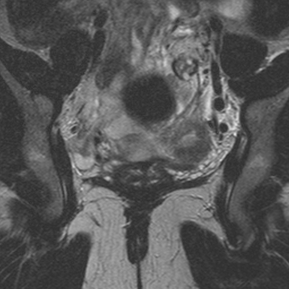 File:Bicornuate uterus (Radiopaedia 24677-24949 Coronal T2 12).jpg