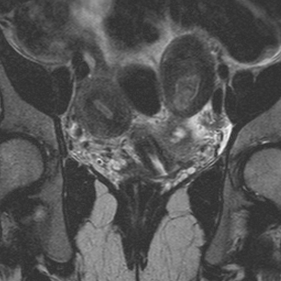 File:Bicornuate uterus (Radiopaedia 24677-24949 Coronal T2 6).jpg