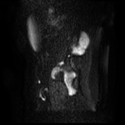 File:Bicornuate uterus (Radiopaedia 51676-57472 Sagittal DWI 48).jpg