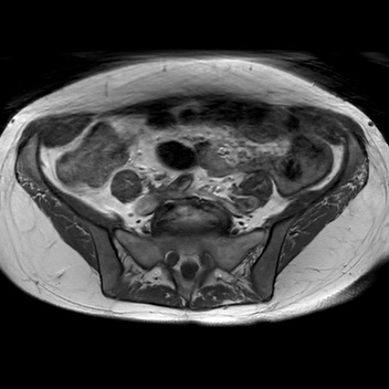 File:Bicornuate uterus (Radiopaedia 61974-70046 Axial T1 16).jpg