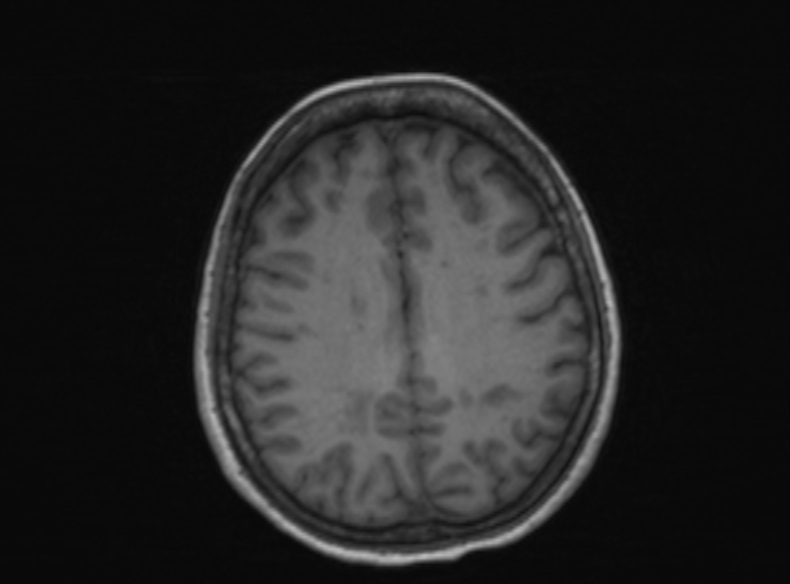 Bilateral PCA territory infarction - different ages (Radiopaedia 46200-51784 Axial T1 190).jpg