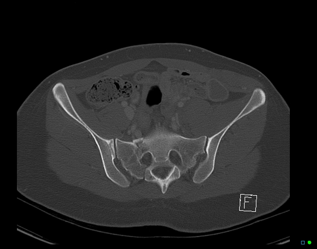 Bilateral acetabular fractures (Radiopaedia 79272-92308 Axial bone window 20).jpg