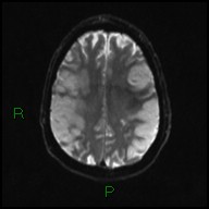 File:Bilateral acute middle cerebral artery territory infarcts (Radiopaedia 77319-89402 Axial DWI 17).jpg