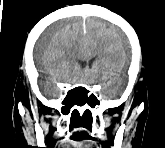 Bilateral acute on chronic subdural hematomas (Radiopaedia 78466-91146 Coronal non-contrast 27).jpg