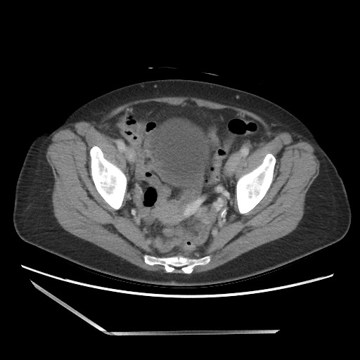 Bilateral adrenal granulocytic sarcomas (chloromas) (Radiopaedia 78375-91007 A 101).jpg