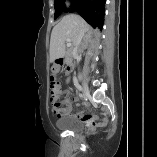 File:Bilateral adrenal granulocytic sarcomas (chloromas) (Radiopaedia 78375-91007 C 61).jpg