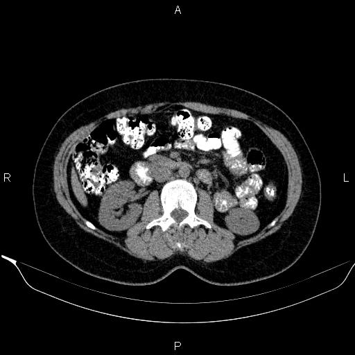File:Bilateral adrenal myelolipoma (Radiopaedia 63058-71535 Axial non-contrast 80).jpg
