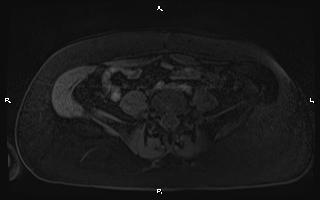 Bilateral adrenal myelolipoma (Radiopaedia 63058-71537 Axial T1 C+ fat sat 79).jpg