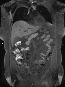 Bilateral adrenal myelolipoma (Radiopaedia 63058-71537 Coronal T1 fat sat 73).jpg