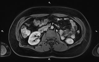 Bilateral adrenal myelolipoma (Radiopaedia 63058-71537 G 54).jpg
