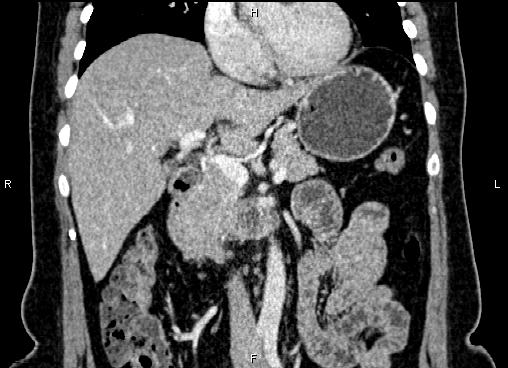Bilateral benign adrenal adenomas (Radiopaedia 86912-103124 D 25).jpg