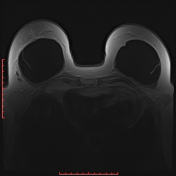 File:Bilateral breast implant rupture (Radiopaedia 24761-25027 PASTA 19).jpg