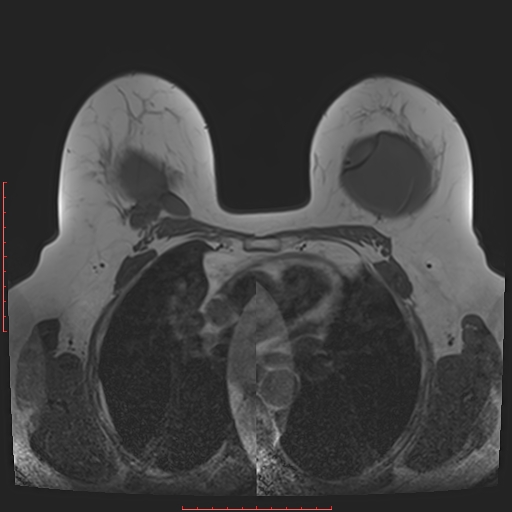 File:Bilateral breast implant rupture (Radiopaedia 24761-25027 T1 15).jpg