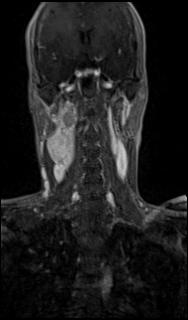 Bilateral carotid body tumors and right glomus jugulare tumor (Radiopaedia 20024-20060 MRA 33).jpg
