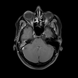 File:Bilateral carotid body tumors and right jugular paraganglioma (Radiopaedia 20024-20060 Axial 111).jpg