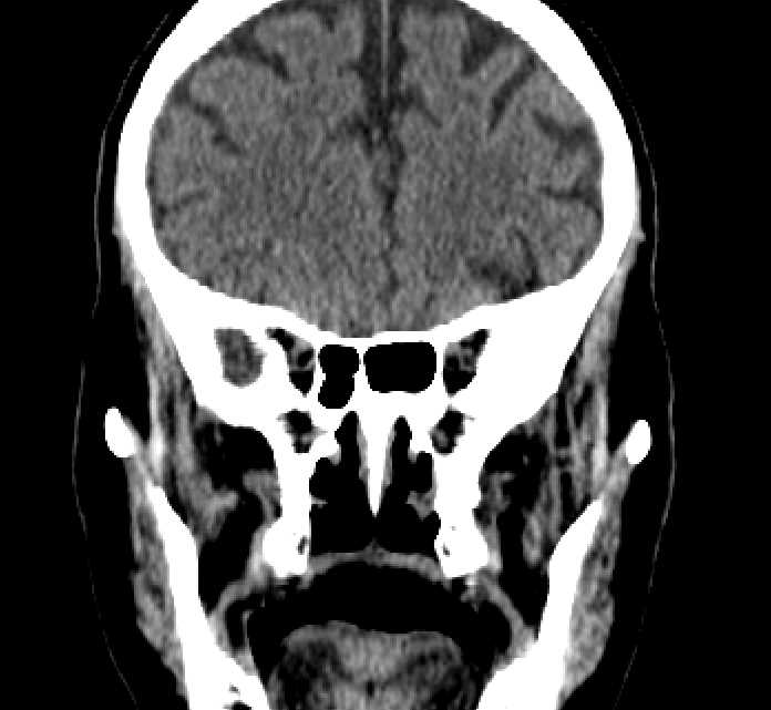 Bilateral ectopia lentis (Radiopaedia 89889-107013 Coronal non-contrast 98).jpg