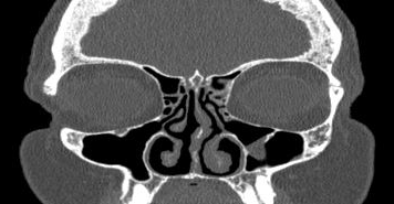 File:Bilateral ectopic infraorbital nerves (Radiopaedia 49006-54084 Coronal 48).png