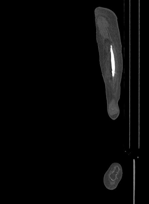 Bilateral fibular hemimelia type II (Radiopaedia 69581-79491 Sagittal bone window 20).jpg