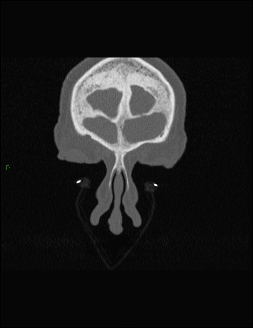 Bilateral frontal mucoceles (Radiopaedia 82352-96454 Coronal 48).jpg