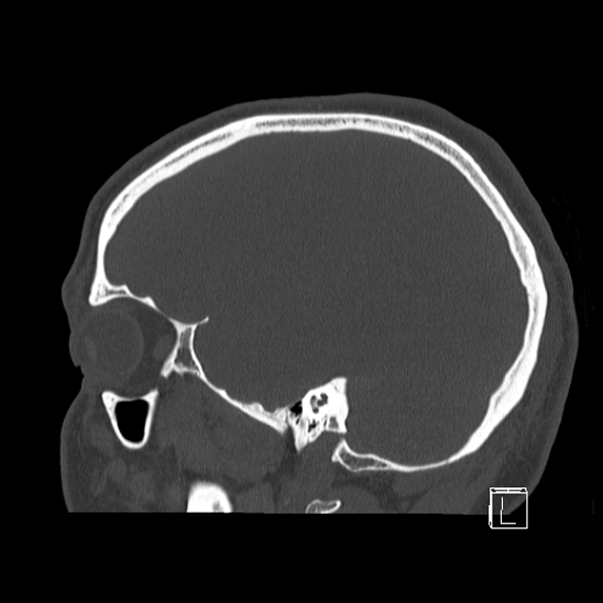 Bilateral occipital condyle fracture (type 2) (Radiopaedia 87675-104089 Sagittal bone window 22).jpg