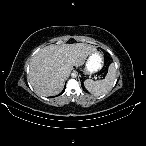 File:Bilateral ovarian dermoid cysts (Radiopaedia 85785-101603 A 24).jpg
